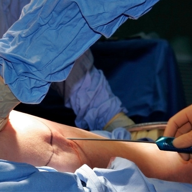 LIPOSUCTION