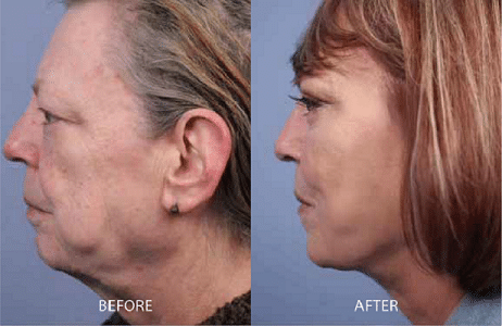 Facelift Liverpool