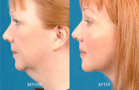 Non-Surgical Facelift