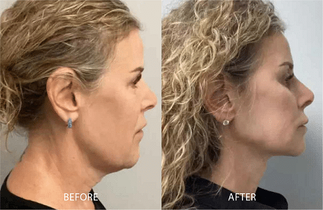 Non-Surgical Facelift Liverpool