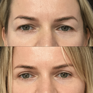 blepharoplasty treatment