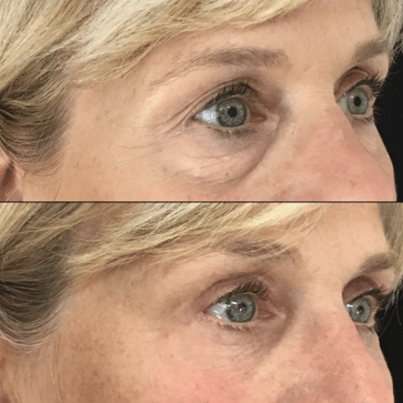 upper blepharoplasty treatment