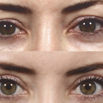 blepharoplasty Liverpool