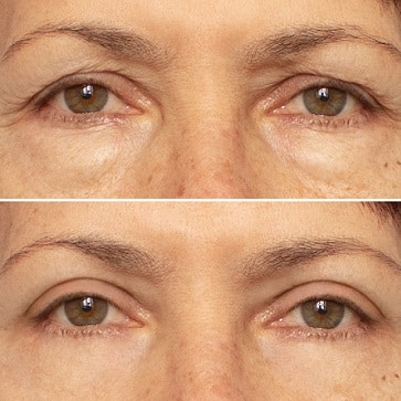 blepharoplasty