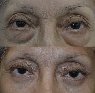 Lower Blepharoplasty Liverpool