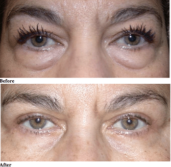 Lower Blepharoplasty in Liverpool