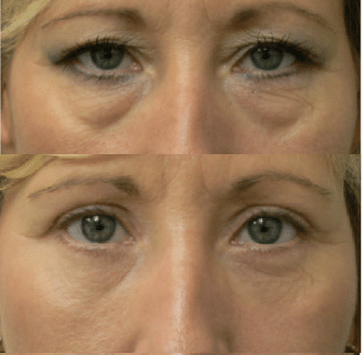 Lower Blepharoplasty