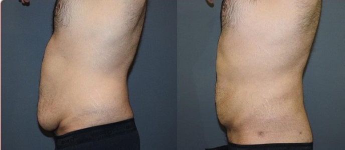 VASER LIPO1