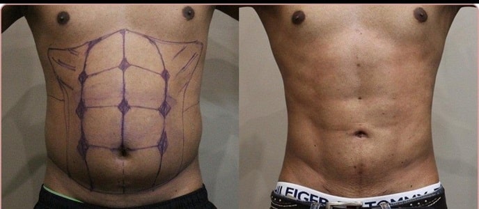 VASER LIPO2