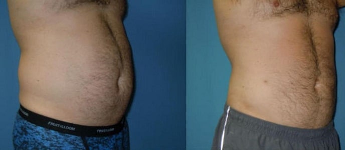 VASER LIPO3