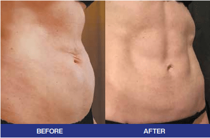 Renuvion body treatment