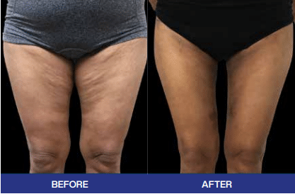 body contouring Liverpool