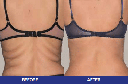 skin tightening Liverpool