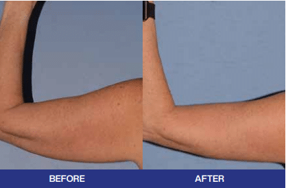 cosmetic surgery Liverpool