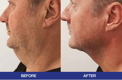j plasma before and after
