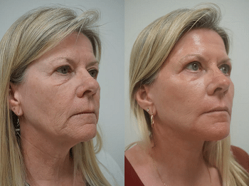 advanced facial renewal