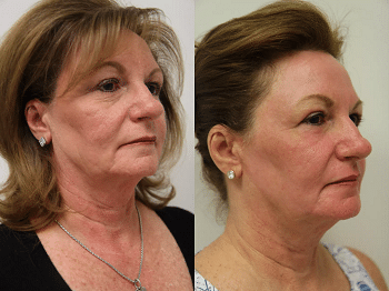 Non-surgical skin tightening