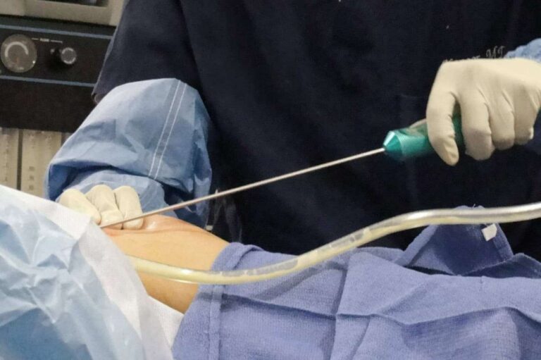 best Vaser surgeon Liverpool