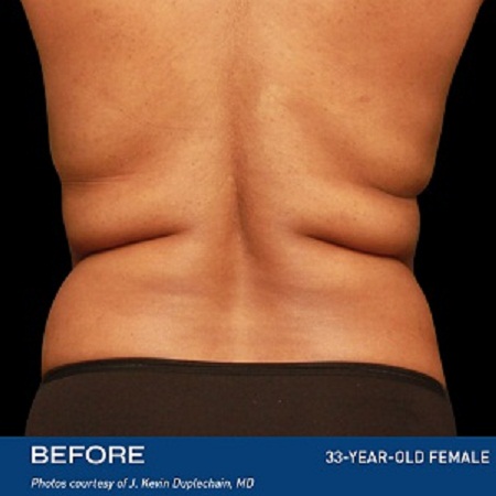 Skin Tightening After Weight Loss