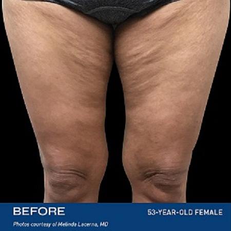 skin tightening Liverpool