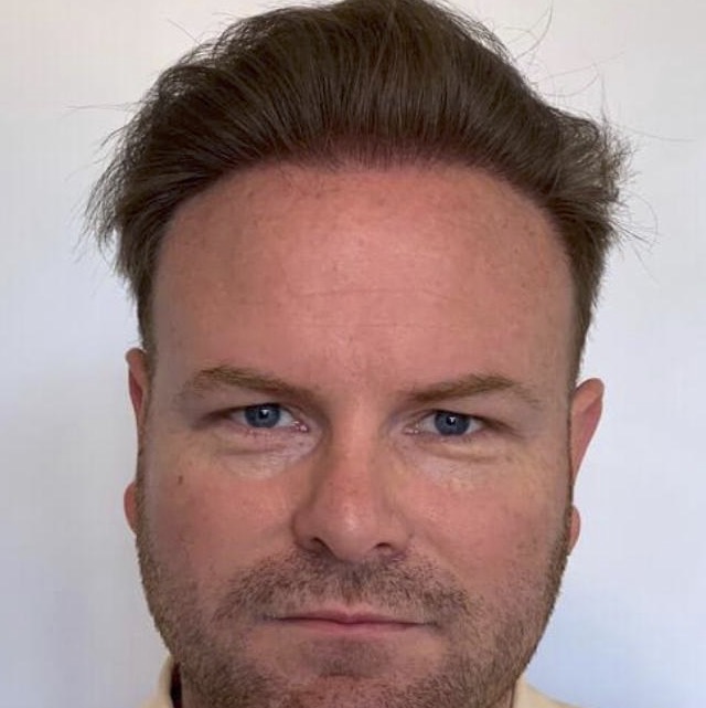 hair transplant liverpool after image