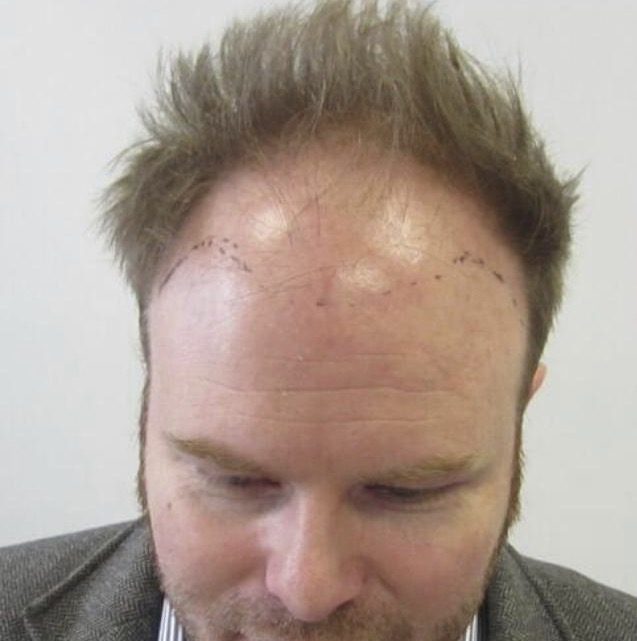 hair transplant liverpool before image