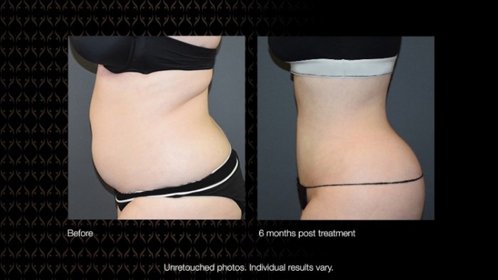 body sculpting clinic Liverpool