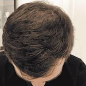 hair transplant liverpool after image