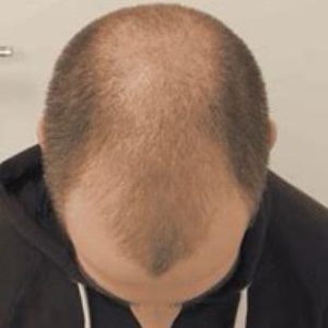 hair transplant liverpool before image
