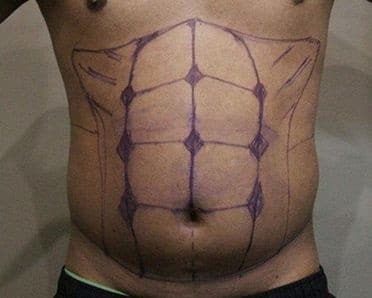 VASER Liposuction for Men