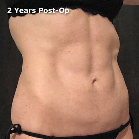 body skin tightening