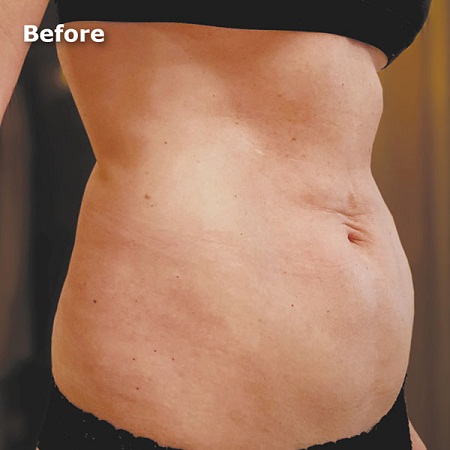 body skin tightening Liverpool