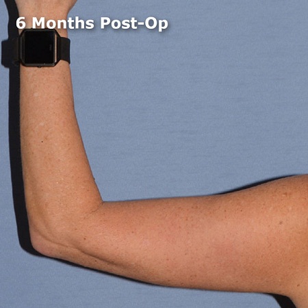 Skin Tightening After Weight Loss in Liverpool