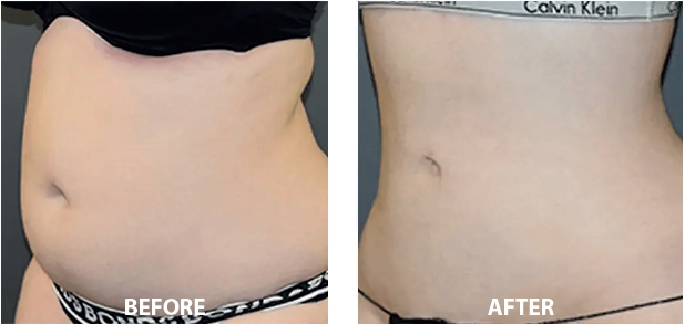 best Vaser surgeon Liverpool