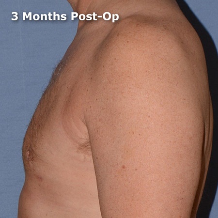 body contouring Liverpool