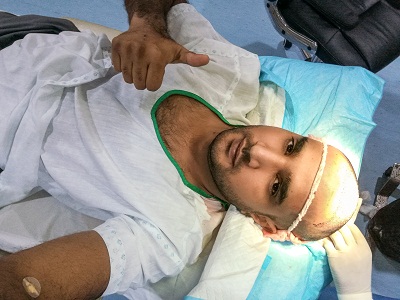 Hair Transplants in Liverpool