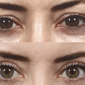 blepharoplasty liverpool