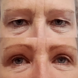 eyebag removal