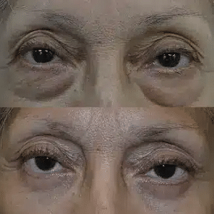 eyelid surgery liverpool