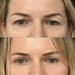 local anaesthetic eyelid surgery liverpool