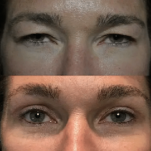 lower eyelid surgery liverpool
