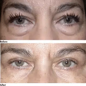 upper eyelid surgery liverpool