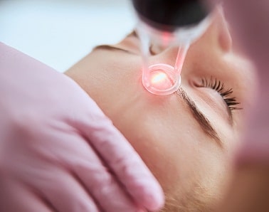 CO2 Laser vs blepharoplasty