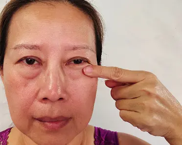 Eye Bag Removal Liverpool