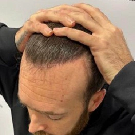hair transplant patient after image