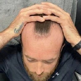 hair transplant patient before image