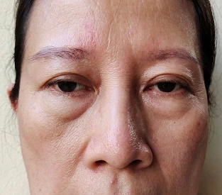 Blepharoplasty Liverpool