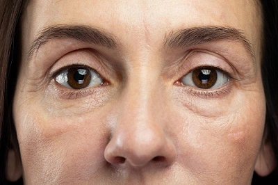 Lower Blepharoplasty