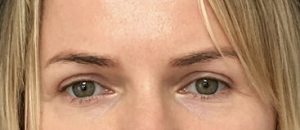 best blepharoplasty clinic liverpool