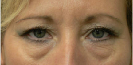 Blepharoplasty
